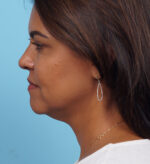 Face Lift/Neck Lift