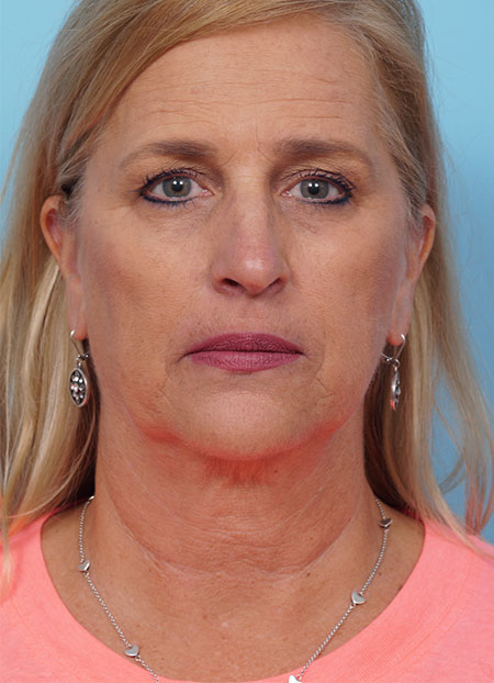 Face Lift/ Mini Lift/ Neck Lift