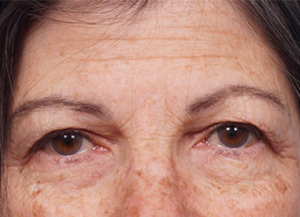 Brow Lift