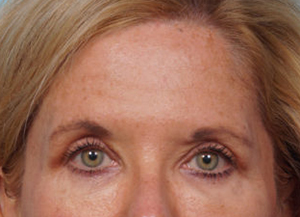 Brow Lift