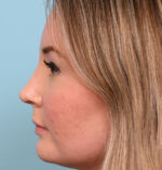 Rhinoplasty