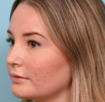 Rhinoplasty