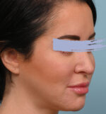 Rhinoplasty