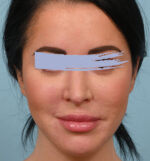 Rhinoplasty