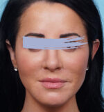 Rhinoplasty