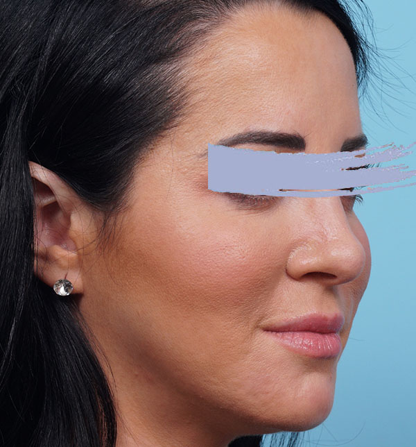 Rhinoplasty