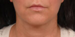 Face Lift/ Mini Lift/ Neck Lift