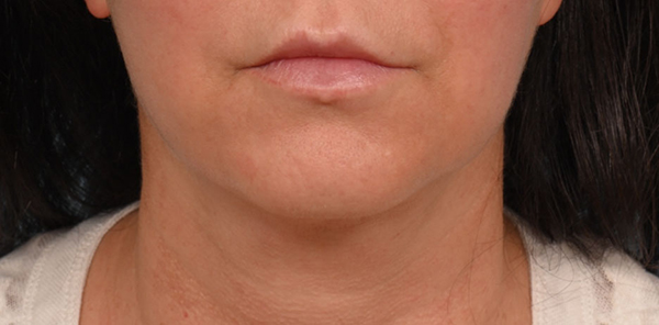 Face Lift/ Mini Lift/ Neck Lift