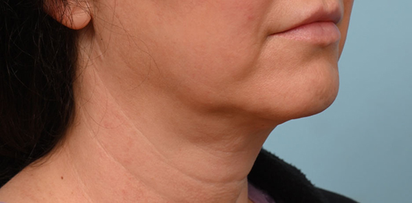 Face Lift/ Mini Lift/ Neck Lift