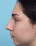 Rhinoplasty