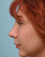 Rhinoplasty