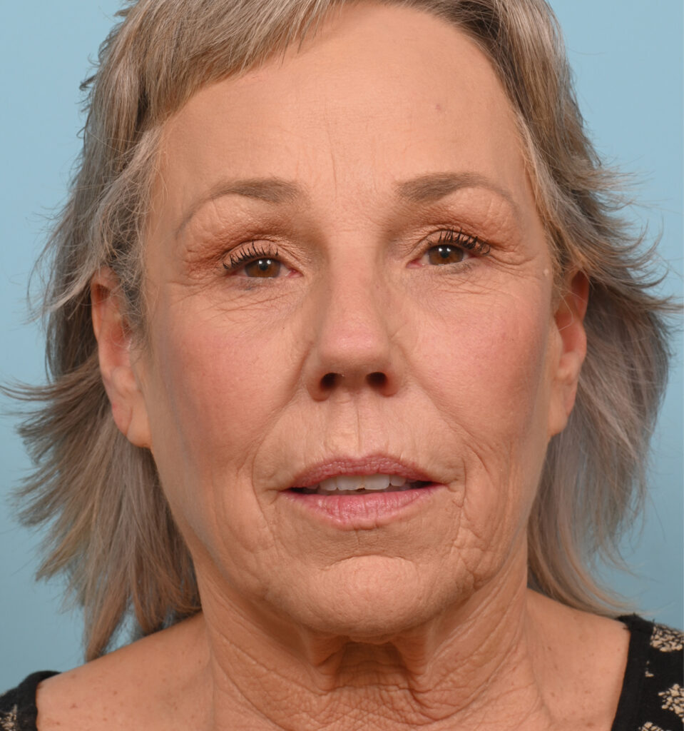 Face Lift/Neck Lift