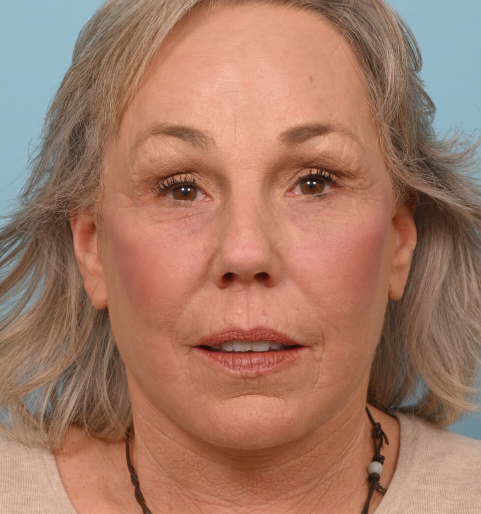 Face Lift/Neck Lift