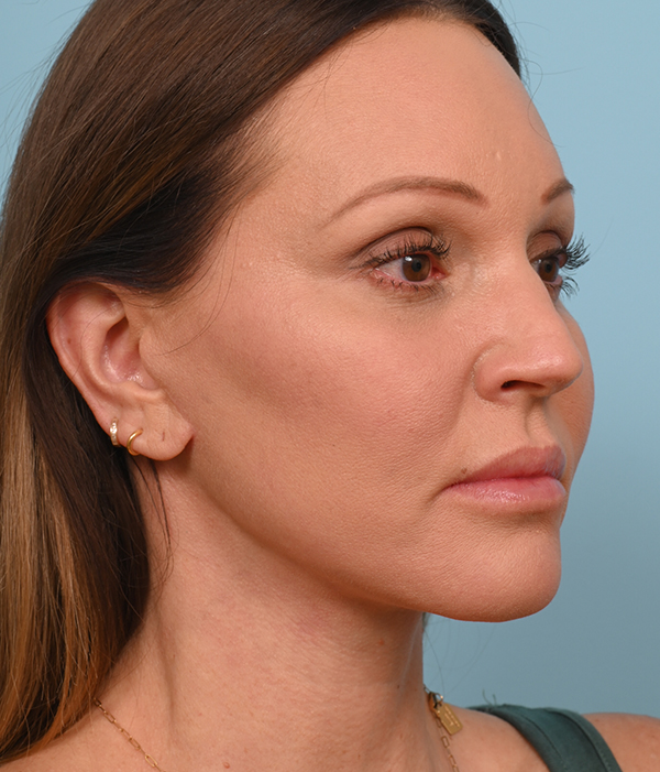 Face Lift/ Mini Lift/ Neck Lift