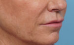 Lip Lift