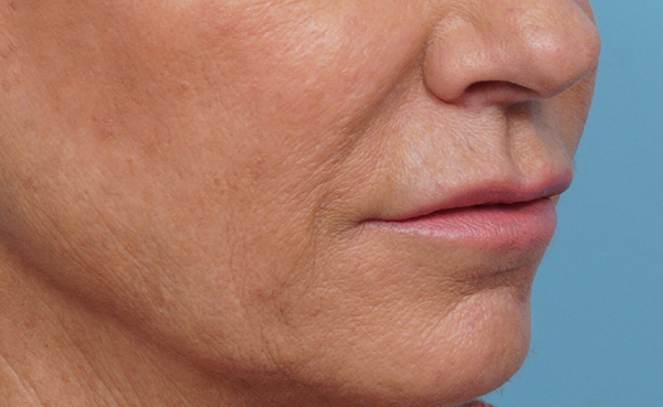 Lip Lift