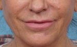 Lip Lift
