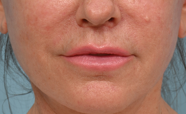Lip Lift