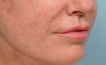 Lip Lift