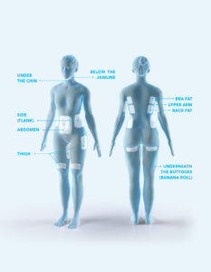 Treatment Areas Graphic