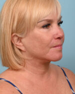 Face Lift/ Mini Lift/ Neck Lift