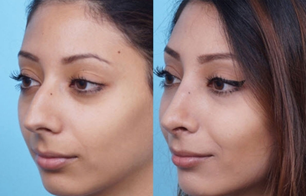 Revision Rhinoplasty Before & After Murrieta