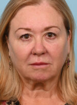 Face Lift/Neck Lift