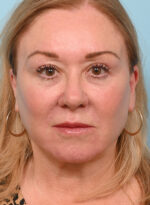 Face Lift/Neck Lift
