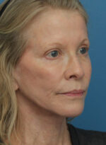 Face Lift/Neck Lift