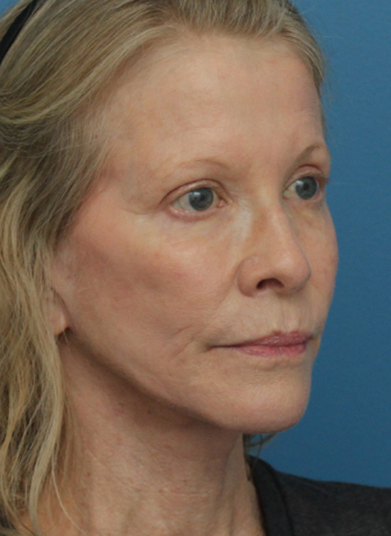 Face Lift/Neck Lift