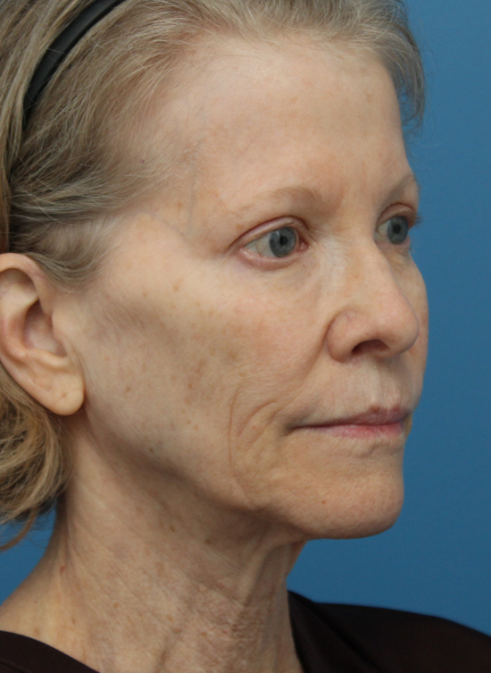 Face Lift/Neck Lift