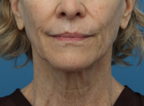 Face Lift/Neck Lift