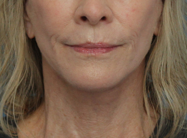 Facial Fat Transfer