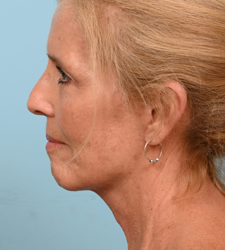 Face Lift/ Mini Lift/ Neck Lift