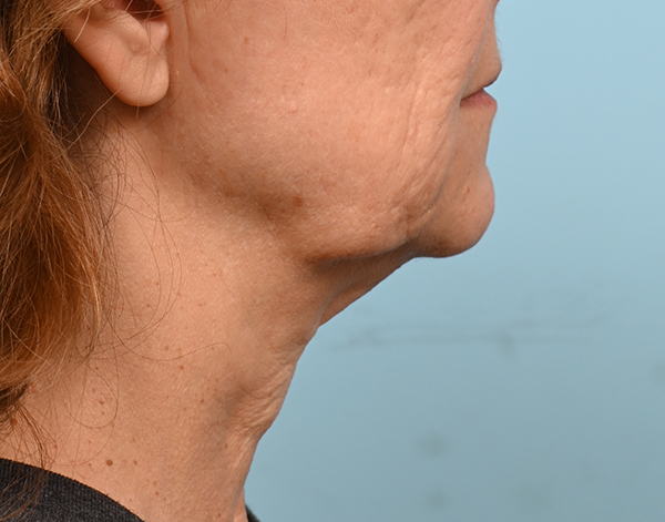 Face Lift/ Mini Lift/ Neck Lift