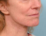 Face Lift/Neck Lift