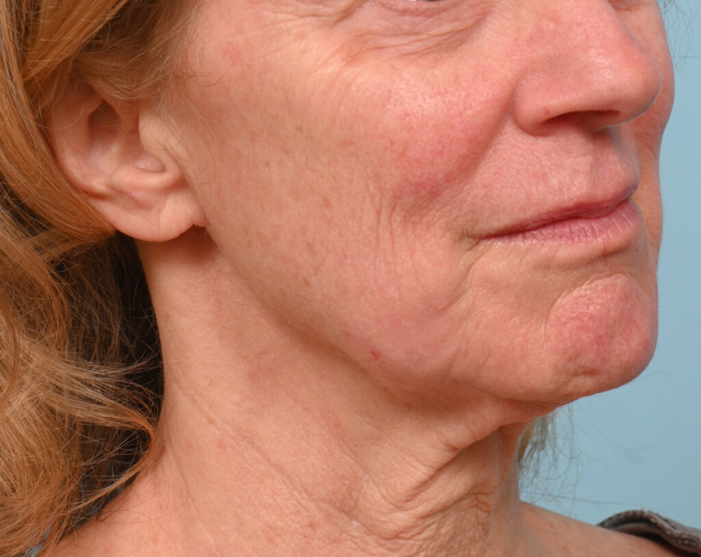 Face Lift/Neck Lift
