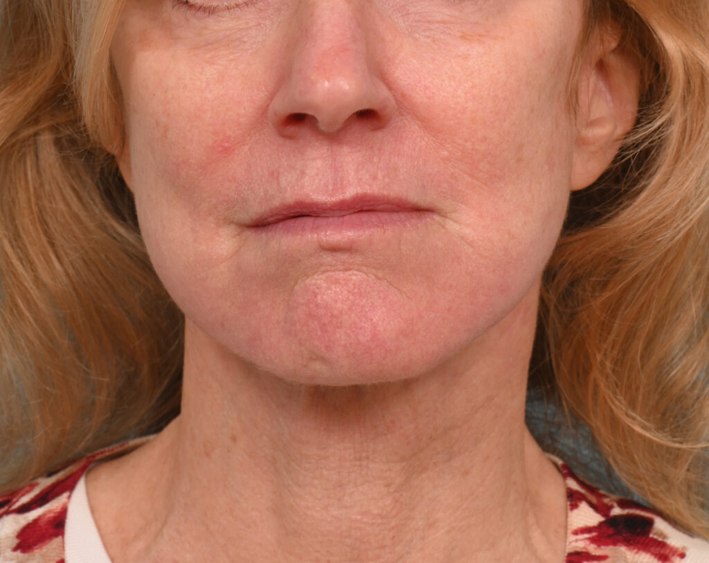 Face Lift/Neck Lift