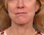 Face Lift/Neck Lift