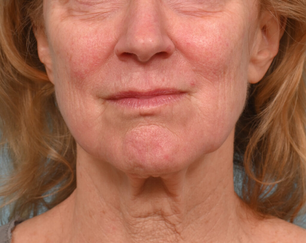 Face Lift/Neck Lift