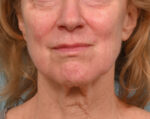 Face Lift/Neck Lift