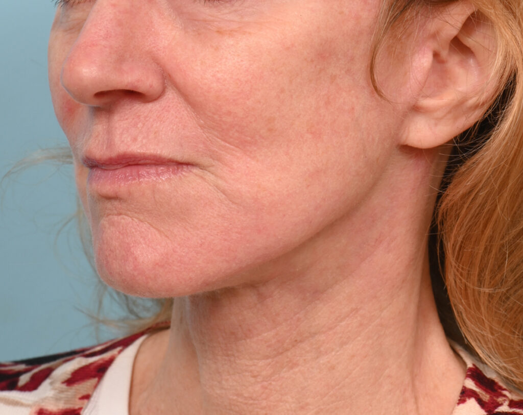 Face Lift/Neck Lift
