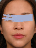 Rhinoplasty