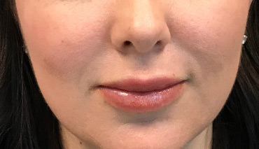 Lip Augmentation/Injectables