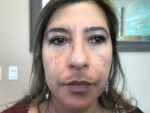 Laser/Chemical Peel