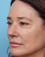 Rhinoplasty
