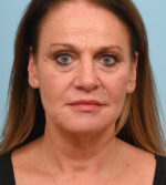 Face Lift/Neck Lift