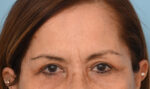 Brow Lift