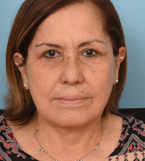 Face Lift/Neck Lift