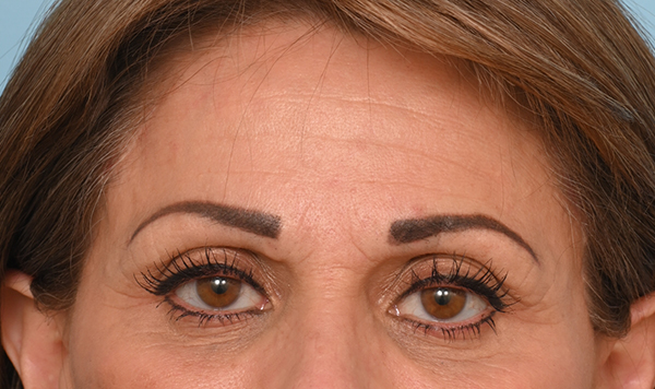 Brow Lift